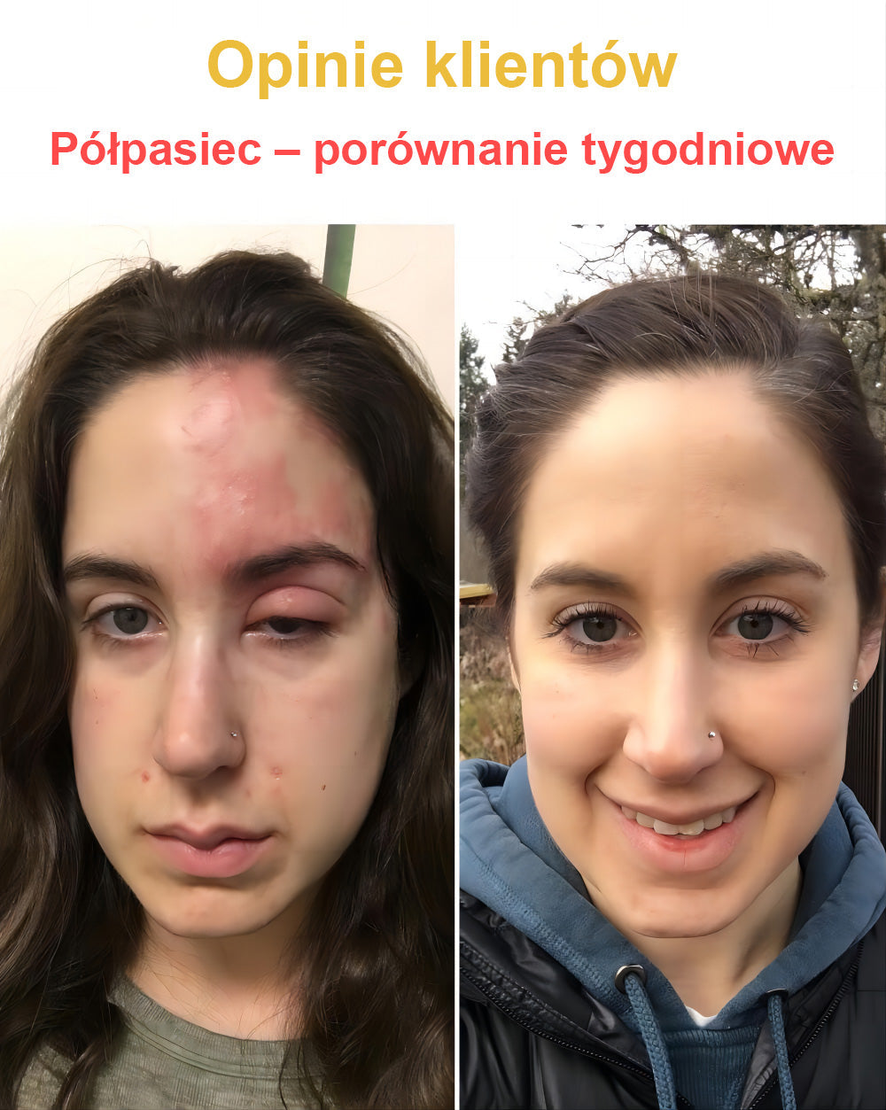 𝑽𝒆𝒍𝒊𝒔𝒔𝒆™ 𝑲𝒓𝒆𝒎 𝒛 𝑱𝒂𝒅ó𝒘 𝑷𝒔𝒛𝒄𝒛𝒆𝒍𝒊𝒄𝒉, 𝒏𝒂 𝑼𝒔𝒖𝒘𝒂𝒏𝒊𝒆 𝑩𝒓𝒐𝒅𝒂𝒘𝒆𝒌, 𝑻𝒓ą𝒅𝒛𝒊𝒌𝒖 𝒊 𝑩𝒍𝒊𝒛𝒏 - 𝑳𝒆𝒄𝒛𝒚 𝑾𝒊𝒆𝒍𝒆 𝑷𝒓𝒐𝒃𝒍𝒆𝒎ó𝒘 𝑺𝒌ó𝒓𝒏𝒚𝒄𝒉 (🧑⚕️𝒁𝒂𝒍𝒆𝒄𝒂𝒏𝒆 𝒑𝒓𝒛𝒆𝒛 𝑨𝑨𝑫)