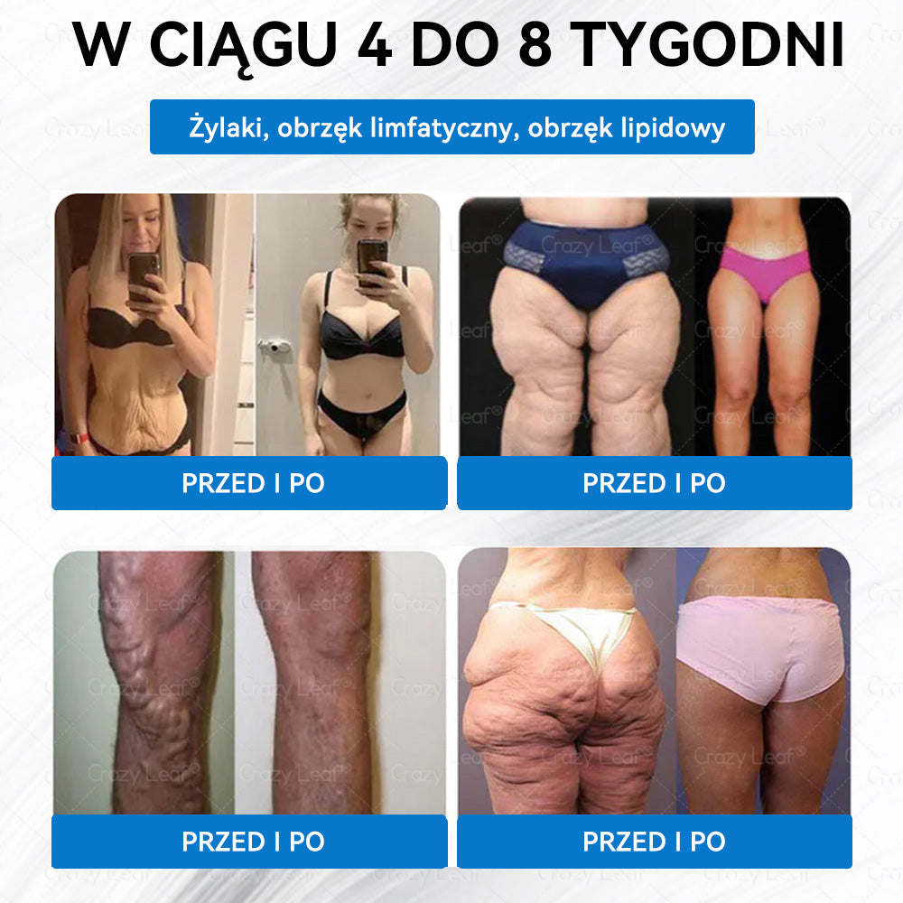 Klinicznie potwierdzone|Oficjalny sklep|𝐶𝑟𝑎𝑧𝑦𝐿𝑒𝑎𝑓® SMGT- GLP-1 Nano Microneedle Slim& Firm Patch|Działa na otyłość, wiotką skórę, nadciśnienie, cukrzycę, stłuszczenie wątroby, bóle stawów, bóle ciała i inne dolegliwości